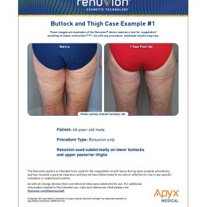 Buttock & Thigh Case 1